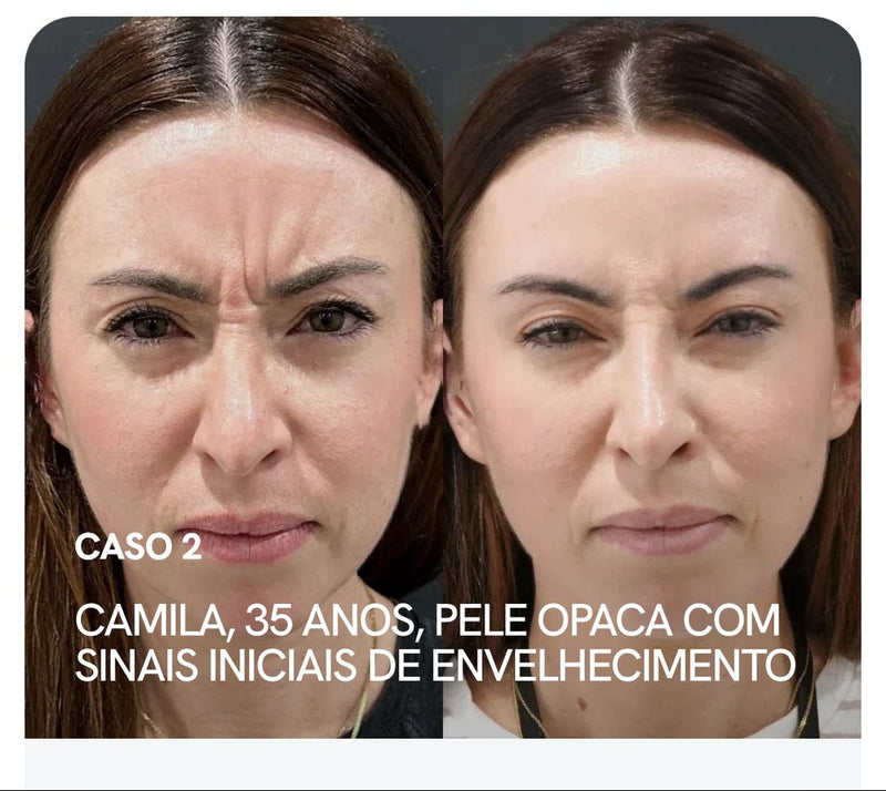 Eye Skin™ - Sérum Clareador de Olheiras Roll-On  - Com Niacinamida 5% e Vitamina C - Efeito Lifting Instantâneo