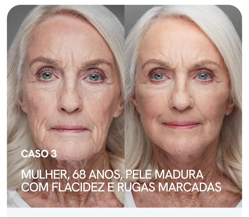 Eye Skin™ - Sérum Clareador de Olheiras Roll-On  - Com Niacinamida 5% e Vitamina C - Efeito Lifting Instantâneo