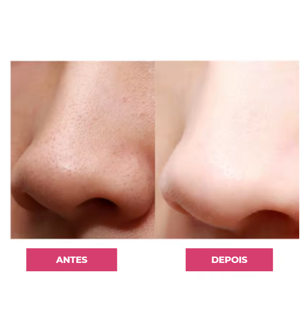 Limpador Facial Peeling Ultrassônico Removedor de Cravos e Espinhas